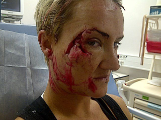 Illustration for article titled A Gruesome Wipe-Out Left This Surfer With Coral Lodged In Her Face